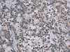 The image on the left is immunohistochemistry of paraffin-embedded Human liver cancer tissue using CSB-PA798917 (TP53AIP1 Antibody) at dilution 1/50, on the right is treated with synthetic peptide. (Original magnification: ×200)