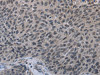 The image on the left is immunohistochemistry of paraffin-embedded Human lung cancer tissue using CSB-PA798917 (TP53AIP1 Antibody) at dilution 1/50, on the right is treated with synthetic peptide. (Original magnification: ×200)