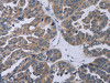 The image on the left is immunohistochemistry of paraffin-embedded Human ovarian cancer tissue using CSB-PA261892 (TP53AIP1 Antibody) at dilution 1/50, on the right is treated with synthetic peptide. (Original magnification: ×200)