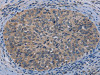 The image on the left is immunohistochemistry of paraffin-embedded Human cervical cancer tissue using CSB-PA261892 (TP53AIP1 Antibody) at dilution 1/50, on the right is treated with synthetic peptide. (Original magnification: ×200)