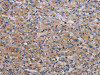 The image on the left is immunohistochemistry of paraffin-embedded Human prostate cancer tissue using CSB-PA182949 (RPS6KB2 Antibody) at dilution 1/40, on the right is treated with synthetic peptide. (Original magnification: ×200)