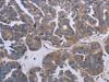 The image on the left is immunohistochemistry of paraffin-embedded Human ovarian cancer tissue using CSB-PA947926 (PARP4 Antibody) at dilution 1/20, on the right is treated with synthetic peptide. (Original magnification: ×200)