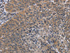 The image on the left is immunohistochemistry of paraffin-embedded Human cervical cancer tissue using CSB-PA057327 (PARP3 Antibody) at dilution 1/20, on the right is treated with synthetic peptide. (Original magnification: ×200)