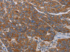 The image on the left is immunohistochemistry of paraffin-embedded Human ovarian cancer tissue using CSB-PA776699 (PARP10 Antibody) at dilution 1/30, on the right is treated with synthetic peptide. (Original magnification: ×200)