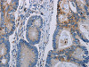 The image on the left is immunohistochemistry of paraffin-embedded Human colon cancer tissue using CSB-PA992379 (PARP10 Antibody) at dilution 1/30, on the right is treated with synthetic peptide. (Original magnification: ×200)