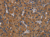 The image on the left is immunohistochemistry of paraffin-embedded Human liver cancer tissue using CSB-PA146607 (PDGFC Antibody) at dilution 1/40, on the right is treated with synthetic peptide. (Original magnification: ×200)