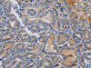 The image on the left is immunohistochemistry of paraffin-embedded Human thyroid cancer tissue using CSB-PA274876 (PYY Antibody) at dilution 1/30, on the right is treated with synthetic peptide. (Original magnification: ×200)
