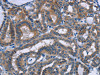The image on the left is immunohistochemistry of paraffin-embedded Human thyroid cancer tissue using CSB-PA020661 (PLIN1 Antibody) at dilution 1/30, on the right is treated with synthetic peptide. (Original magnification: ×200)