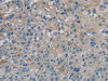 The image on the left is immunohistochemistry of paraffin-embedded Human liver cancer tissue using CSB-PA281298 (PGLYRP1 Antibody) at dilution 1/40, on the right is treated with synthetic peptide. (Original magnification: ×200)