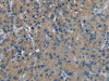 The image on the left is immunohistochemistry of paraffin-embedded Human liver cancer tissue using CSB-PA942630 (PHKG1 Antibody) at dilution 1/20, on the right is treated with synthetic peptide. (Original magnification: ×200)