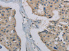 The image on the left is immunohistochemistry of paraffin-embedded Human prostate cancer tissue using CSB-PA942630 (PHKG1 Antibody) at dilution 1/20, on the right is treated with synthetic peptide. (Original magnification: ×200)