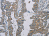The image on the left is immunohistochemistry of paraffin-embedded Human esophagus cancer tissue using CSB-PA304185 (PHKG2 Antibody) at dilution 1/30, on the right is treated with synthetic peptide. (Original magnification: ×200)