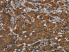 The image on the left is immunohistochemistry of paraffin-embedded Human breast cancer tissue using CSB-PA597940 (PIK3CD Antibody) at dilution 1/20, on the right is treated with synthetic peptide. (Original magnification: ×200)