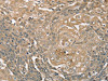 The image on the left is immunohistochemistry of paraffin-embedded Human cervical cancer tissue using CSB-PA193486 (PIK3CD Antibody) at dilution 1/35, on the right is treated with synthetic peptide. (Original magnification: ×200)