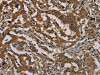 The image on the left is immunohistochemistry of paraffin-embedded Human liver cancer tissue using CSB-PA955430 (PKMYT1 Antibody) at dilution 1/50, on the right is treated with synthetic peptide. (Original magnification: ×200)