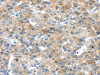 The image on the left is immunohistochemistry of paraffin-embedded Human liver cancer tissue using CSB-PA223469 (PLXNA3 Antibody) at dilution 1/20, on the right is treated with synthetic peptide. (Original magnification: ×200)