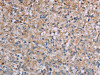 The image on the left is immunohistochemistry of paraffin-embedded Human prostate cancer tissue using CSB-PA226742 (PLXNA4 Antibody) at dilution 1/50, on the right is treated with synthetic peptide. (Original magnification: ×200)