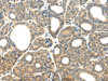 The image on the left is immunohistochemistry of paraffin-embedded Human thyroid cancer tissue using CSB-PA124601 (PLXNB2 Antibody) at dilution 1/20, on the right is treated with synthetic peptide. (Original magnification: ×200)