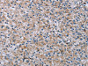 The image on the left is immunohistochemistry of paraffin-embedded Human prostate cancer tissue using CSB-PA796358 (PNPT1 Antibody) at dilution 1/40, on the right is treated with synthetic peptide. (Original magnification: ×200)