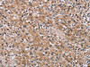 The image on the left is immunohistochemistry of paraffin-embedded Human prostate cancer tissue using CSB-PA558310 (POMT1 Antibody) at dilution 1/40, on the right is treated with synthetic peptide. (Original magnification: ×200)