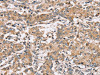 The image on the left is immunohistochemistry of paraffin-embedded Human liver cancer tissue using CSB-PA188909 (PPP1CC Antibody) at dilution 1/40, on the right is treated with synthetic peptide. (Original magnification: ×200)