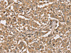 The image on the left is immunohistochemistry of paraffin-embedded Human liver cancer tissue using CSB-PA251592 (PPP1CC Antibody) at dilution 1/40, on the right is treated with synthetic peptide. (Original magnification: ×200)