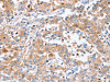 The image on the left is immunohistochemistry of paraffin-embedded Human liver cancer tissue using CSB-PA118443 (PPOX Antibody) at dilution 1/40, on the right is treated with synthetic peptide. (Original magnification: ×200)