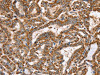 The image on the left is immunohistochemistry of paraffin-embedded Human thyroid cancer tissue using CSB-PA121495 (PPOX Antibody) at dilution 1/40, on the right is treated with synthetic peptide. (Original magnification: ×200)