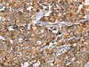 The image on the left is immunohistochemistry of paraffin-embedded Human breast cancer tissue using CSB-PA121495 (PPOX Antibody) at dilution 1/40, on the right is treated with synthetic peptide. (Original magnification: ×200)