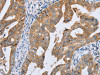 The image on the left is immunohistochemistry of paraffin-embedded Human gastic cancer tissue using CSB-PA546249 (PTGER2 Antibody) at dilution 1/20, on the right is treated with synthetic peptide. (Original magnification: ×200)