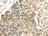 The image on the left is immunohistochemistry of paraffin-embedded Human esophagus cancer tissue using CSB-PA215840 (PROX1 Antibody) at dilution 1/40, on the right is treated with synthetic peptide. (Original magnification: ×200)