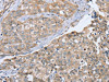 The image on the left is immunohistochemistry of paraffin-embedded Human breast cancer tissue using CSB-PA933387 (CYTH1 Antibody) at dilution 1/40, on the right is treated with synthetic peptide. (Original magnification: ×200)