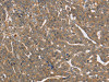 The image on the left is immunohistochemistry of paraffin-embedded Human cervical cancer tissue using CSB-PA776978 (PTPN12 Antibody) at dilution 1/45, on the right is treated with synthetic peptide. (Original magnification: ×200)