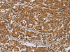 The image on the left is immunohistochemistry of paraffin-embedded Human liver cancer tissue using CSB-PA790236 (RAB8A Antibody) at dilution 1/45, on the right is treated with synthetic peptide. (Original magnification: ×200)