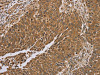 The image on the left is immunohistochemistry of paraffin-embedded Human lung cancer tissue using CSB-PA790236 (RAB8A Antibody) at dilution 1/45, on the right is treated with synthetic peptide. (Original magnification: ×200)