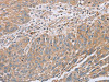 The image on the left is immunohistochemistry of paraffin-embedded Human lung cancer tissue using CSB-PA786453 (RAB8B Antibody) at dilution 1/45, on the right is treated with synthetic peptide. (Original magnification: ×200)