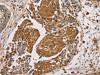 The image on the left is immunohistochemistry of paraffin-embedded Human lung cancer tissue using CSB-PA114224 (MUC1 Antibody) at dilution 1/45, on the right is treated with synthetic peptide. (Original magnification: ×200)