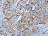 The image on the left is immunohistochemistry of paraffin-embedded Human breast cancer tissue using CSB-PA692815 (MUC1 Antibody) at dilution 1/45, on the right is treated with synthetic peptide. (Original magnification: ×200)