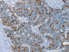 The image on the left is immunohistochemistry of paraffin-embedded Human cervical cancer tissue using CSB-PA692815 (MUC1 Antibody) at dilution 1/45, on the right is treated with synthetic peptide. (Original magnification: ×200)