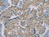 The image on the left is immunohistochemistry of paraffin-embedded Human breast cancer tissue using CSB-PA248994 (RAD51 Antibody) at dilution 1/40, on the right is treated with synthetic peptide. (Original magnification: ×200)