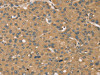 The image on the left is immunohistochemistry of paraffin-embedded Human liver cancer tissue using CSB-PA779455 (KDM5A Antibody) at dilution 1/45, on the right is treated with synthetic peptide. (Original magnification: ×200)