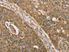 The image on the left is immunohistochemistry of paraffin-embedded Human esophagus cancer tissue using CSB-PA779455 (KDM5A Antibody) at dilution 1/45, on the right is treated with synthetic peptide. (Original magnification: ×200)