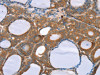 The image on the left is immunohistochemistry of paraffin-embedded Human thyroid cancer tissue using CSB-PA244470 (NOS2 Antibody) at dilution 1/20, on the right is treated with synthetic peptide. (Original magnification: ×200) The image on the left is immunohistochemistry of paraffin-embedded Human thyroid cancer tissue using CSB-PA244470 (NOS2 Antibody) at dilution 1/20, on the right is treated with synthetic peptide. (Original magnification: ×200)