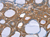 The image on the left is immunohistochemistry of paraffin-embedded Human thyroid cancer tissue using CSB-PA244470 (NOS2 Antibody) at dilution 1/20, on the right is treated with synthetic peptide. (Original magnification: ×200)