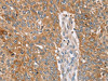 The image on the left is immunohistochemistry of paraffin-embedded Human lung cancer tissue using CSB-PA439984 (NOS2 Antibody) at dilution 1/25, on the right is treated with synthetic peptide. (Original magnification: ×200)