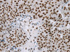 The image on the left is immunohistochemistry of paraffin-embedded Human breast cancer tissue using CSB-PA145306 (ZMIZ1 Antibody) at dilution 1/20, on the right is treated with synthetic peptide. (Original magnification: ×200)