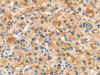 The image on the left is immunohistochemistry of paraffin-embedded Human liver cancer tissue using CSB-PA442653 (RHCG Antibody) at dilution 1/35, on the right is treated with synthetic peptide. (Original magnification: ×200)