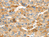 The image on the left is immunohistochemistry of paraffin-embedded Human liver cancer tissue using CSB-PA299946 (RHCG Antibody) at dilution 1/30, on the right is treated with synthetic peptide. (Original magnification: ×200)