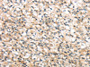 The image on the left is immunohistochemistry of paraffin-embedded Human prostate cancer tissue using CSB-PA299946 (RHCG Antibody) at dilution 1/30, on the right is treated with synthetic peptide. (Original magnification: ×200)