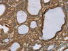 The image on the left is immunohistochemistry of paraffin-embedded Human thyroid cancer tissue using CSB-PA345004 (RNF5 Antibody) at dilution 1/35, on the right is treated with synthetic peptide. (Original magnification: ×200)